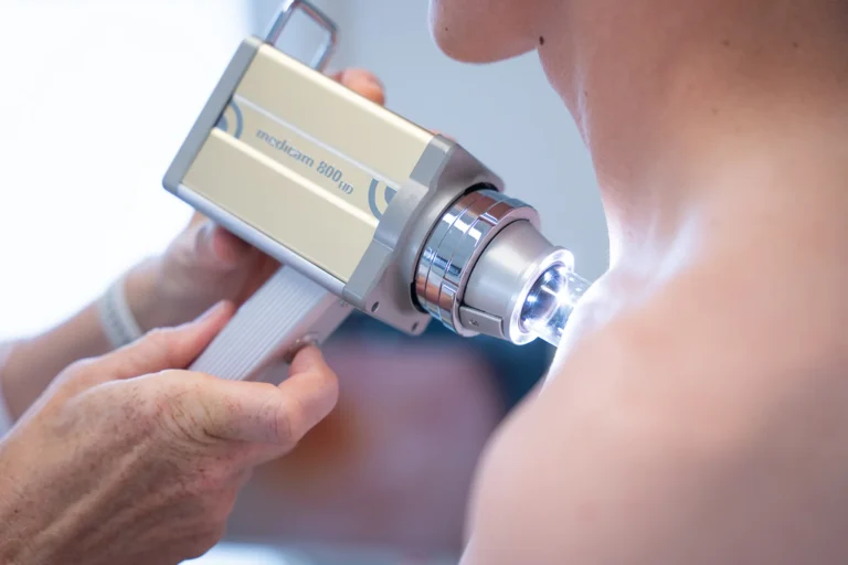 Auflichtmikroskop (medicam) zur Untersuchung einer Hautstelle